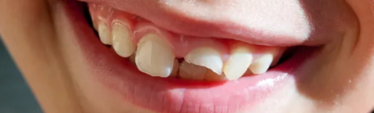 dente quebrado.png